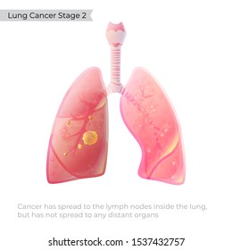 Vector isolated illustration of lung anatomy with tumor. Human respiratory system icon. Second of four stages of lungs cancer. Internal donor organ symbol poster. Image 2 of 4.