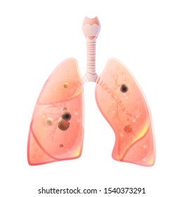 Vector isolated illustration of lung anatomy with cancer tumor. Human respiratory system icon. Healthcare medical center, surgery, hospital, clinic logo. Internal donor organ symbol poster