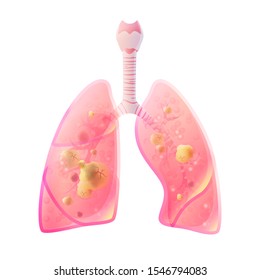 Vector isolated illustration of lung anatomy with tumor. Human respiratory system icon. Forth of four stages of lungs cancer. Internal donor organ symbol poster. Image 4 of 4.