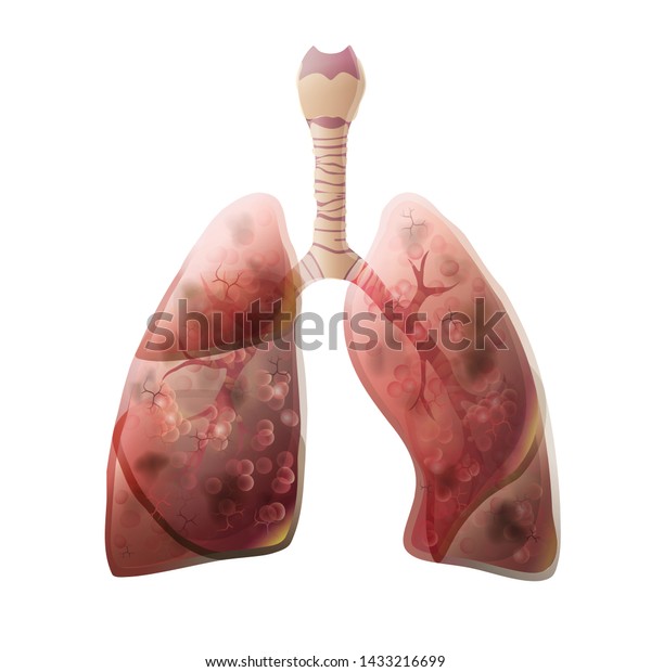 Vector Isolated Illustration Lung Anatomy Cancer Stock Vector (Royalty ...