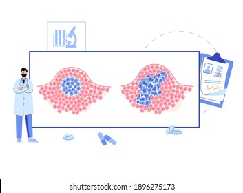 Vector isolated illustration of malignant and benign tumor in healthy tissue. Doctors in laboratory. Spreading of cancer cells, tumor development concept. Medical infographics science and medical use.