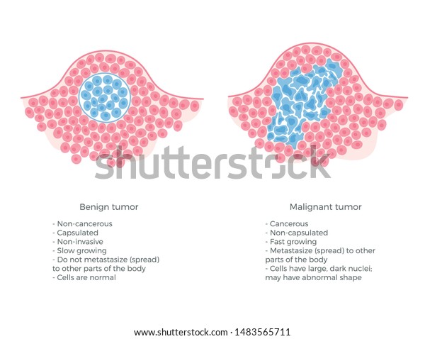 Vector isolated illustration of malignant and benign\
tumor in healthy tissue. Spreading of cancer cells, tumor\
development. Medical infographics for poster, educational, science\
and medical use. 