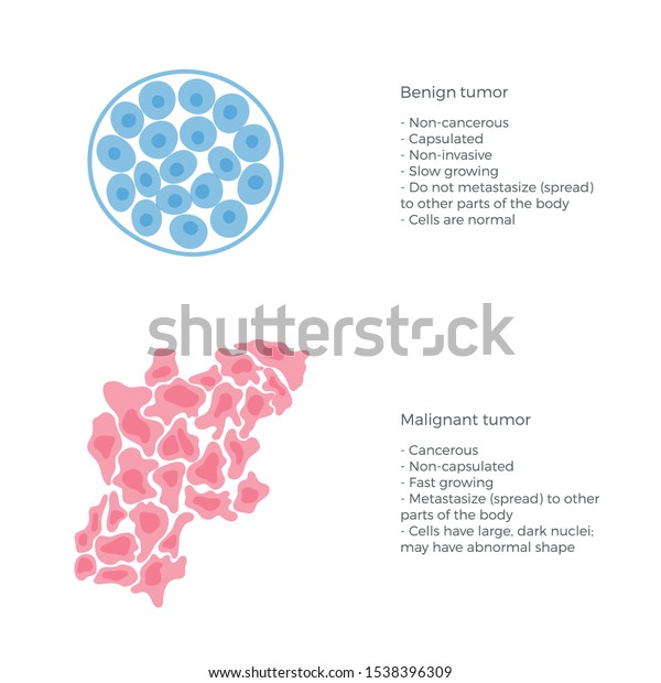 Vector isolated illustration of malignant and benign
tumor in healthy tissue. Spreading of cancer cells, tumor
development. Medical infographics for poster, educational, science
and medical use. 
