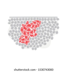 Vector isolated illustration of malignant tumor in healthy tissue. Spreading of cancer cells, tumor development. Medical infographic for poster, educational, science and medical use. 