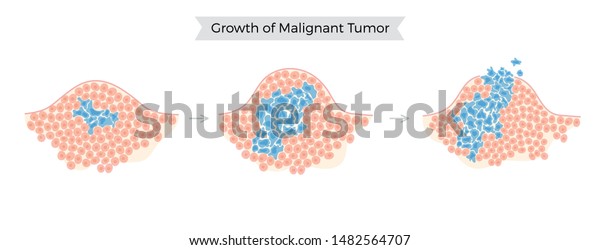 Vector Isolated Illustration Malignant Tumor Healthy Stock Vector Royalty Free 1482564707