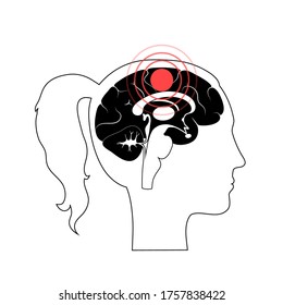 Vector Isolated Illustration Of Pain, Inflammation Or Tumor In Head. Brain Components Detailed In Adult Female Anatomy. Occipital, Frontal, Parietal And Temporal Lobe. Medical Infographics For Poster.