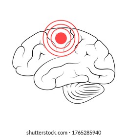 Vector isolated illustration of pain, inflammation or tumor in human brain anatomy cerebrum and cerebellum. Brain structure Medical infographics for poster, educational and science.