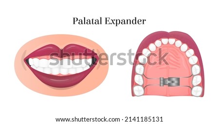 Vector isolated illustration with palatal expander, bottom view. Concept treatment of orthodontic problems, straightening and fixing of teeth, orthodontic structures. It can be used in banner design