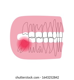 Vector isolated illustration of permanent human teeth dentition. Upper and lower jaw. Wisdom tooth mesial impaction anatomy. Side view. Medical banner or poster illustration.