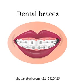 Vector isolated illustration of a smiling mouth with metal dental braces. The concept dentistry, orthodontics, alignment of teeth, a beautiful smile. It can be used in posters, flyers, web design, etc
