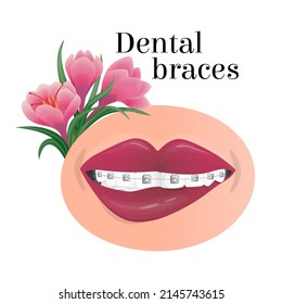 Vector isolated illustration of a smiling mouth with metal dental braces. The concept dentistry, orthodontics, alignment of teeth, a beautiful smile. Floral background, with crocuses.