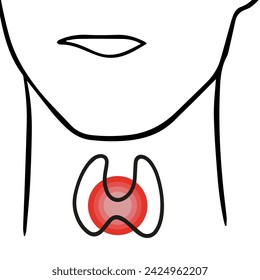 Ilustración aislada del vector de la glándula tiroides . Glándula tiroides agrandada.	