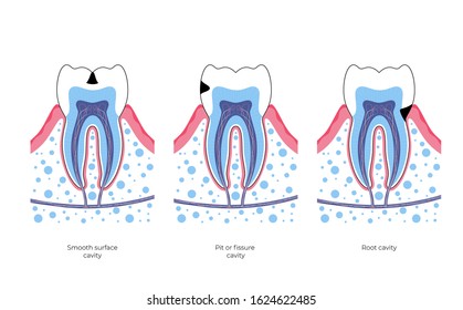 Vector Isolated Illustration Of Tooth With Caries. Types Of Teeth Decay Medical Poster. Banner For Dentist Office, Dentistry Clinic