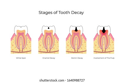 Vector isolated illustration of tooth with caries. Stages of teeth decay development medical poster. Banner for dentist office, dentistry clinic. Enamel and dentin decay