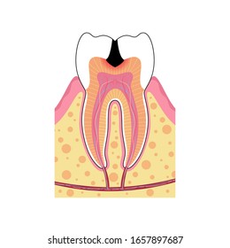 Vector Isolated Illustration Of Tooth With Caries. Teeth Decay Medical Poster. Pulp Decay And Pulp Infection. Banner For Dentist Office, Dentistry Clinic