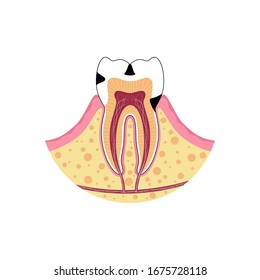 Vector isolated illustration of tooth with caries. Types of teeth decay medical poster. Banner for dentist office, dentistry clinic