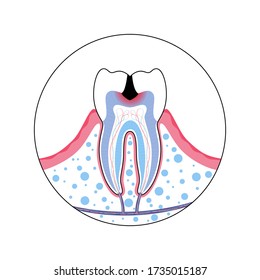 Vector Isolated Illustration Of Tooth With Caries. Teeth Decay Medical Poster. Pulp Decay And Pulp Infection. Banner For Dentist Office, Dentistry Clinic