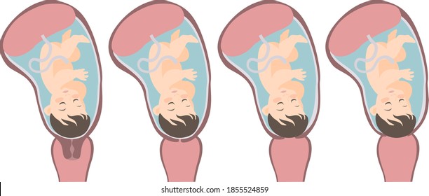 Vector Isolated Image Of The First Stage Of Labor /, Where The Human Embryo Descends Into The Uterus, The Cervix Is ​​smoothed And Dilated. For Information In Gynecology, Medicine