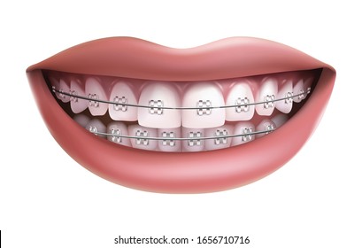 cartoon braces teeth