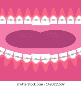 Vector Medical Braces Teeth. Dental Care Background. Orthodontic Treatment. Cartoon Opening Mouth.