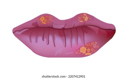 Vector medical illustration of herpes labialis, cold sores or fever blisters on lips. Oral herpes isolated on a white background. Viral infection caused by herpes simplex virus. Small blisters, sores.