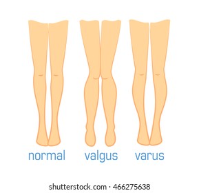 Vector medical illustration human leg curvatures human feet Infographic. Plastic surgery, treatment diseases leg bones, toe alignment Infographic. Ilizarov method colored illustration human leg.