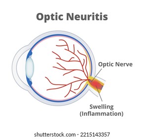 Vector medical illustration of optic neuritis isolated on white background. Nerve fibers are inflamed, and the optic nerve is swollen. Temporary vision loss and visual field loss. Eye inflammation.