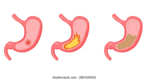 Ilustración médica vectorial del estómago dentro. Estomago saludable y personajes de estómago enfermo. Gastritis y reflujo ácido, indigestión, vómitos, ardor de estómago y problemas de dolor de estómago.