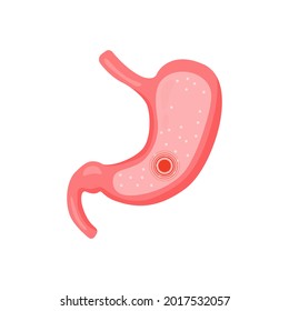 Ilustración médica vectorial del estómago dentro. Estomago saludable y personajes de estómago enfermo. Gastritis y reflujo ácido, indigestión, vómitos, ardor de estómago y problemas de dolor de estómago.