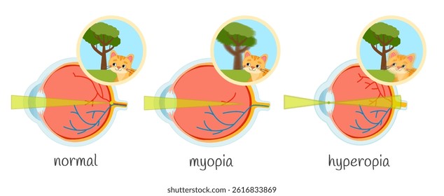 Vector medical illustration of vision impairment. Eye diseases myopia, hyperopia.

