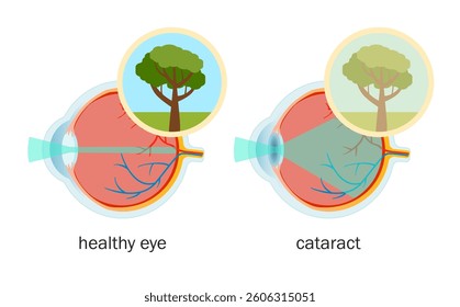 Vector medical poster of anatomy of healthy eye and eye with cataract.
