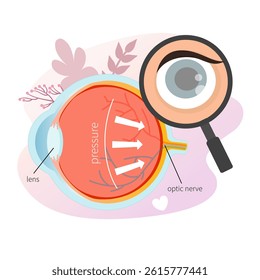 Vector medical poster glaucoma. Eye diseases. Increased intraocular pressure illustration.
