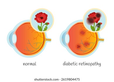 Cartaz médico vetorial olho e olho normais com retinopatia diabética.
