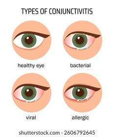 Vector medical poster types of conjunctivitis.
