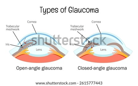 Vector medical poster types of glaucoma. Open-angle and closed-angle glaucoma on eye anatomy.
