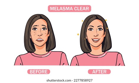 Vector of Melasma before and after on the woman face.