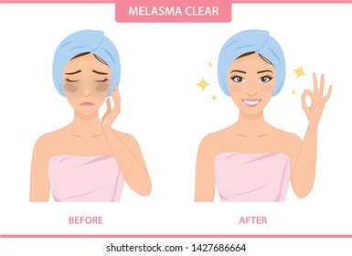 Melasma Images, Stock Photos & Vectors | Shutterstock