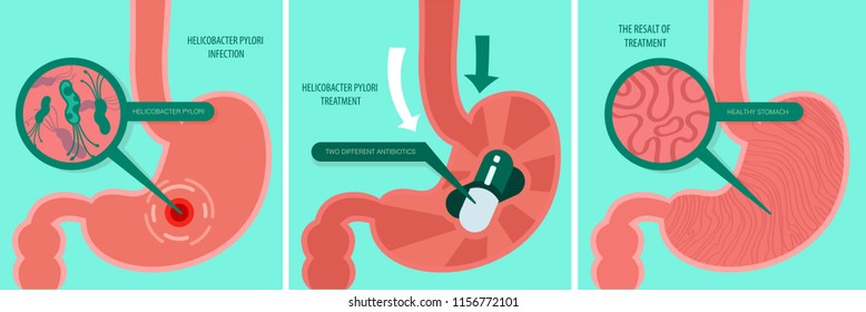 Vector Minimalistic Illustration Of A Stomach Helicobacter Pylori Infection And Treatment