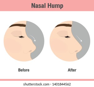 Vector of nose reconstruction or nasal hump removal comparison of nose after plastic surgery with circle frame