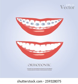 vector orthodontics sign on gray background.teeth with braces.vector illustration