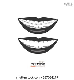 vector orthodontics sign on white background.teeth with braces.vector illustration.