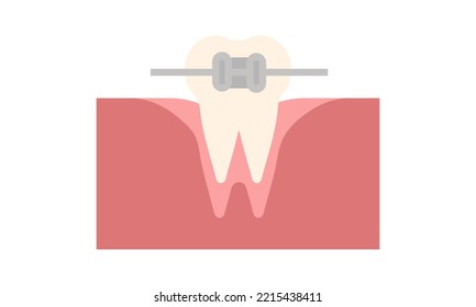 Vector Orthodontics. Tooth with metal braces and bracket system. Dental icon. Web pictogram for dentistry. Stomatology concept, logo or illustration. Orthodontist orthopedist specialization emblem.