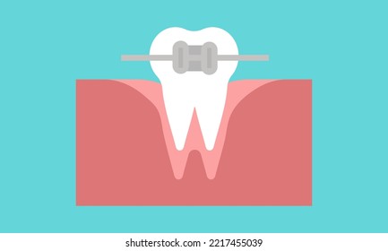 Vector Orthodontics. Tooth with metal braces and bracket system. Dental icon. Web pictogram for dentistry. Stomatology concept, logo or illustration. Orthodontist orthopedist specialization emblem.