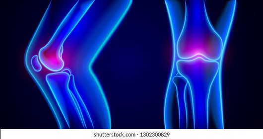 Vector painful knees  x-ray.