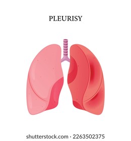 Enfermedad de pleuria vectorial, diseño de ilustración para medicina