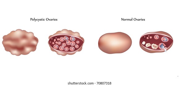 Vector Polycystic Ovary And Normal Ovary Differences