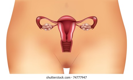 Vector Polycystic Ovary Syndrome