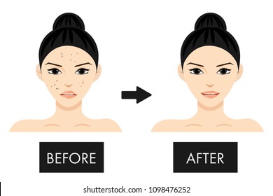 Vector portrait woman face before and after acne and black spot. Skin care concept. Cartoon character isolated on white background