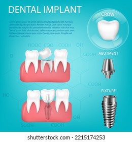 20,498 Dental Implant Isolated Stock Vectors, Images & Vector Art ...