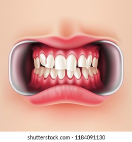 Vector realistic crooked teeth before braces dental installation, brakets system. Teeth care, dentist medical concept. Oral hygiene, orthodontics treatment. Healthcare, correct bite